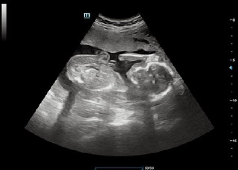 baby presentation scan